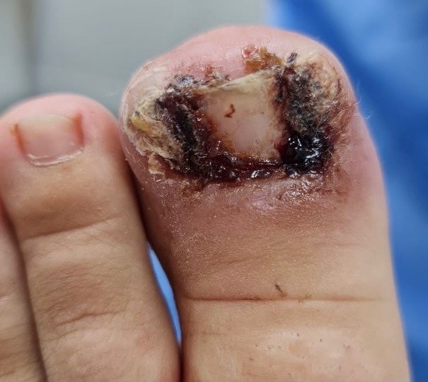 Ingrowing toenails causing you problems? Try a nail avulsion!