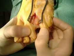 Neuroma Surgery (Trapped Nerves)
