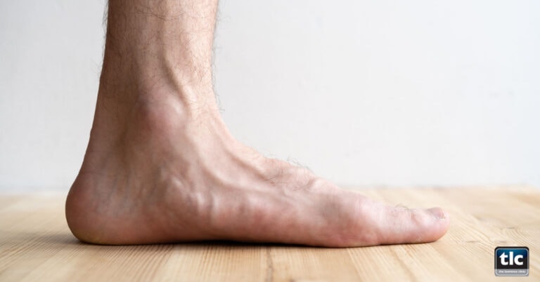 Can flat feet be corrected? 4 top questions answered about flat feet
