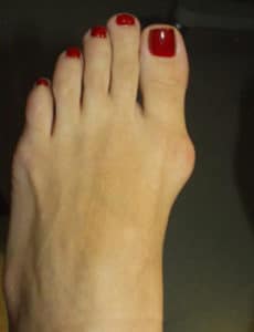 before bunion surgery