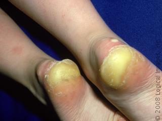 Chiropody Treatment for Corns and Callus