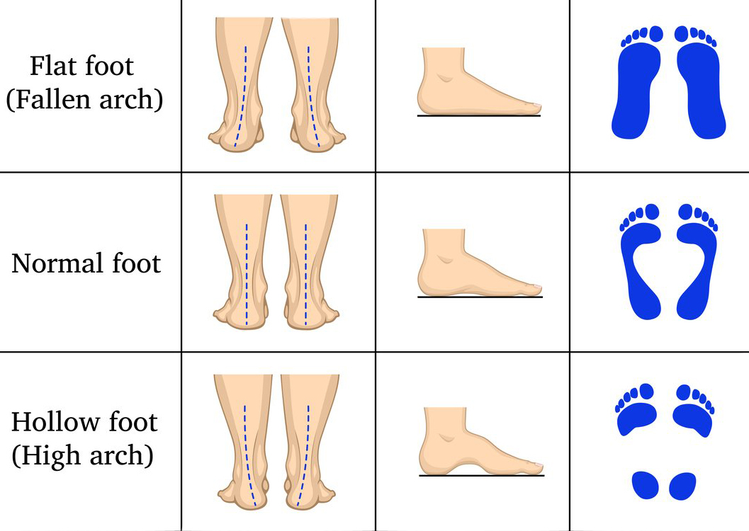 flat vs normal feet