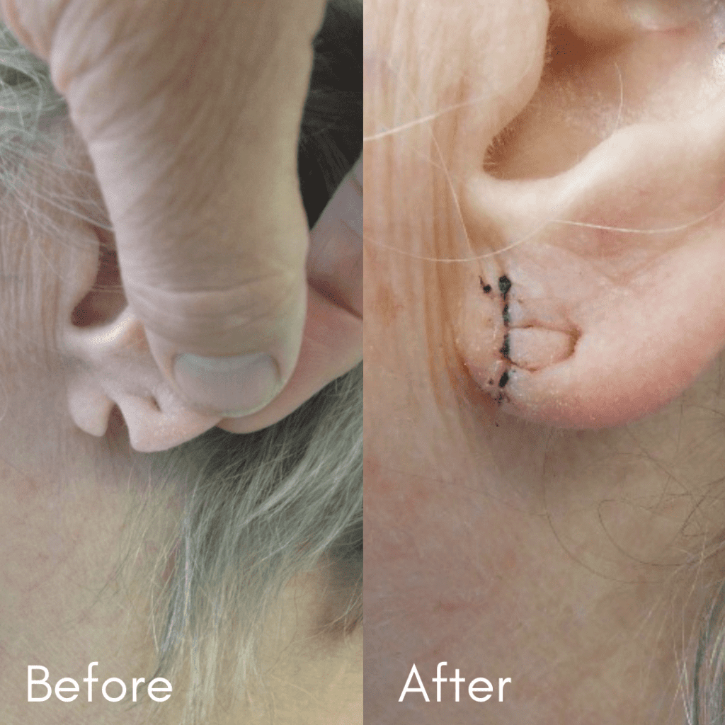 Split' earlobe repair